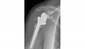 Insurer Backs Down and Pays $237k Settlement to 76 Year Old DJD Client