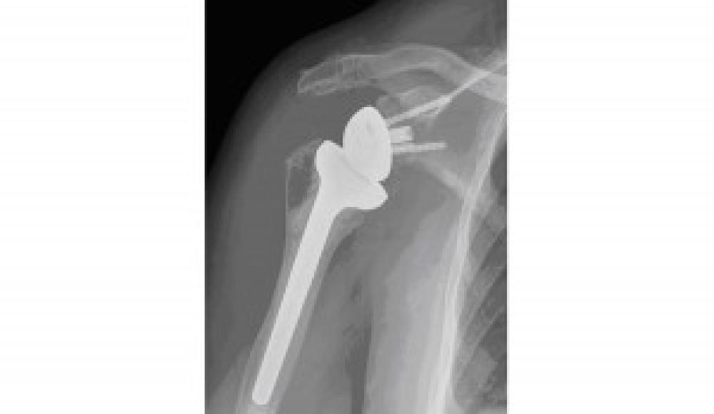 Insurer Backs Down and Pays $237k Settlement to 76 Year Old DJD Client