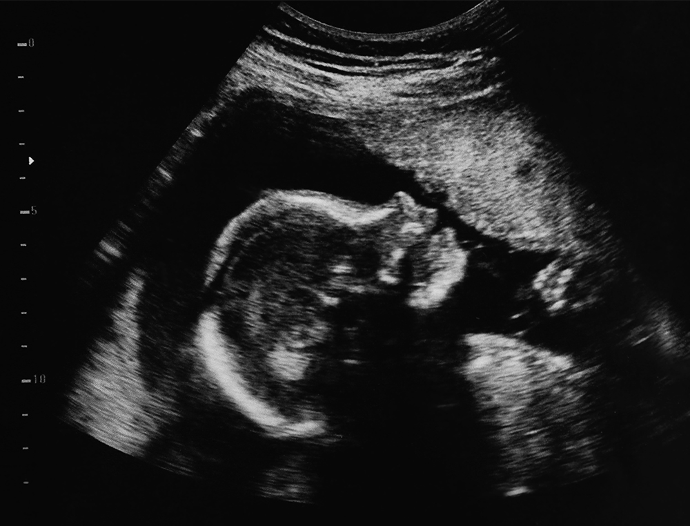 ultrasound photo