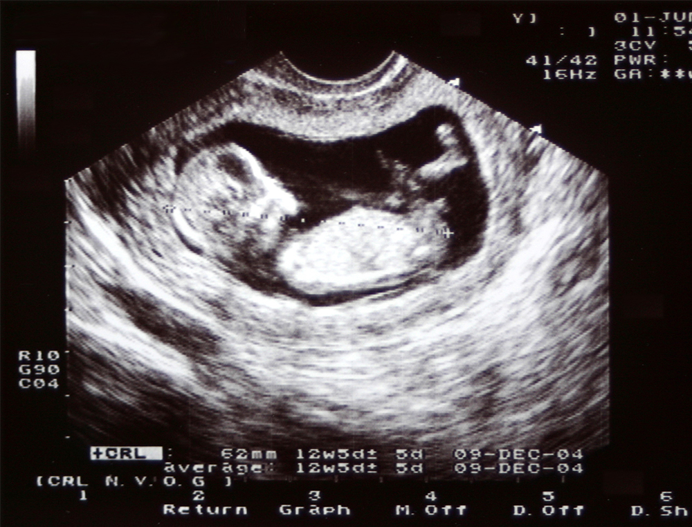 Georgia Heartbeat Bill