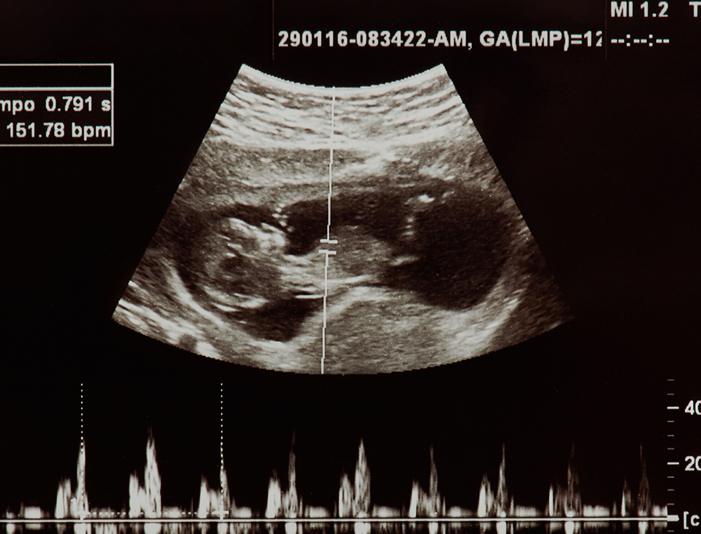 Circuit Court Stops Trump Admin. from Enforcing Title X Ban on Funding Abortion Clinics