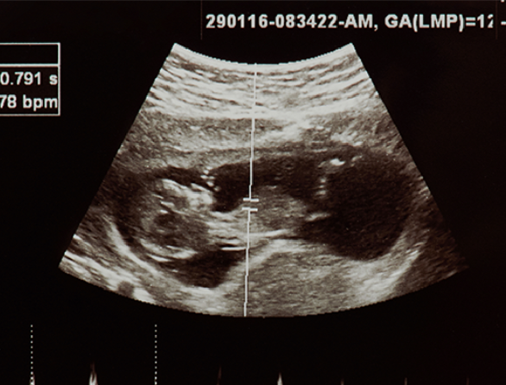 Ohio legislature passes bill requiring humane burial for aborted babies