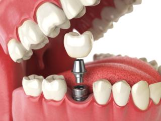 how tooth implants work