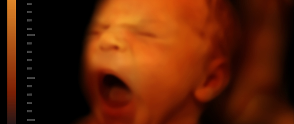 My Prediction After State’s Oral Argument Defending Abortion Ban Laws
