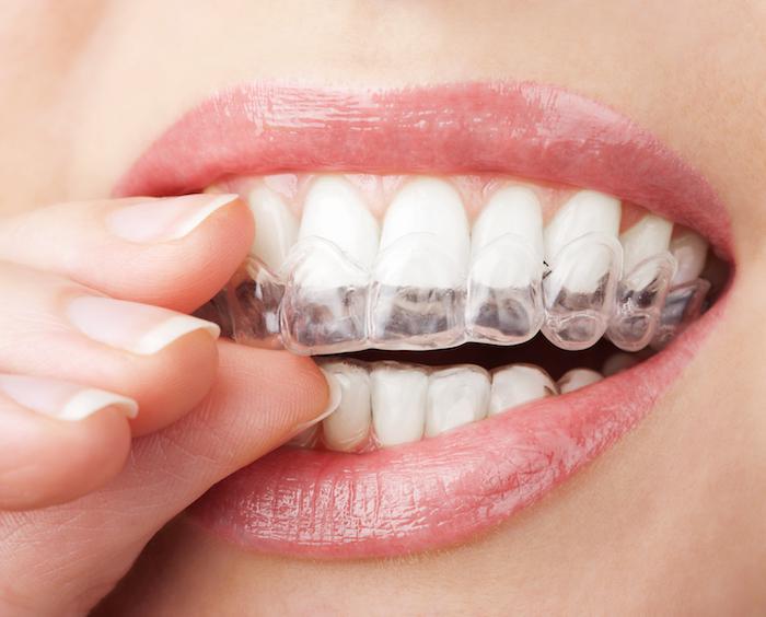 Get Clear Aligners With SmileDirectClub