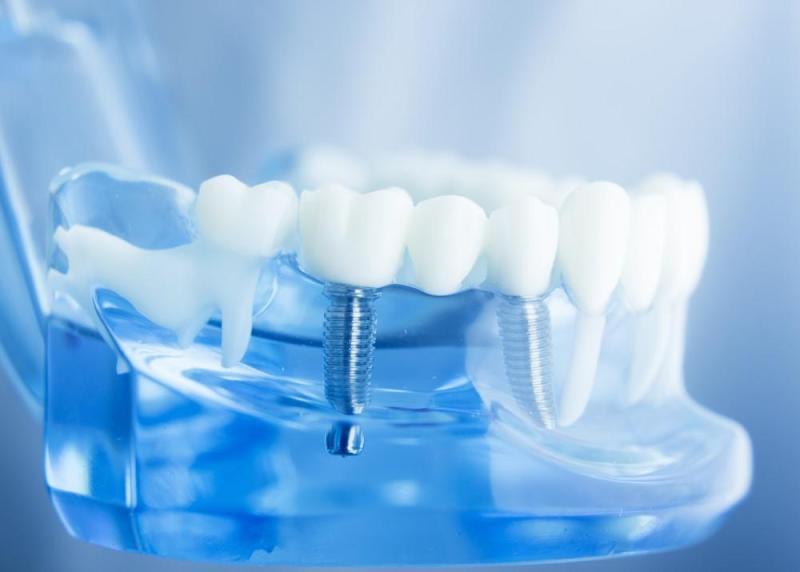 5 Reasons Dental Implants Are Superior to Other Teeth Replacement Options