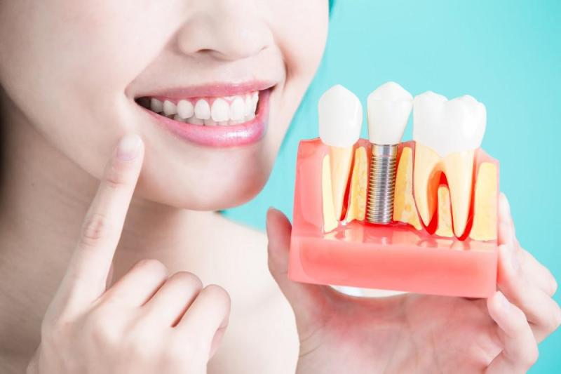 3 Top Reasons Why Dental Implants Have Gained So Much Popularity
