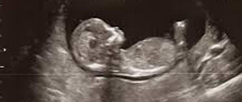 Abortion Was Not the Real Issue in Roe v. Wade