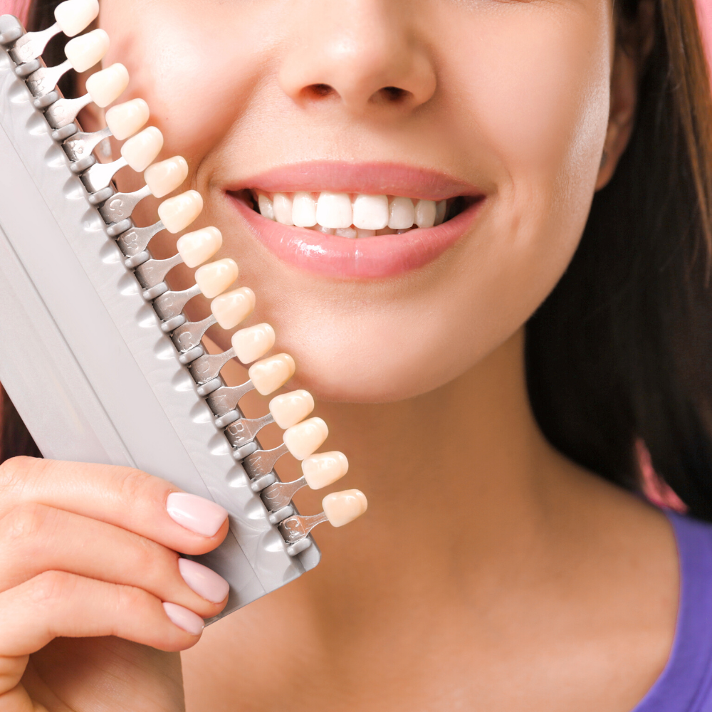 What to Expect When You're Expecting Veneers