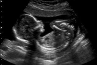 Court Upholds Ban On Tennessee Heartbeat Abortion Bill