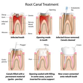 Root Canal Treatment Diagram
