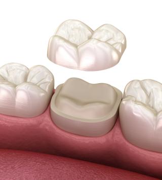 Dental Tooth Crown Diagram