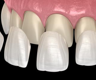 Tooth Veneers Diagram
