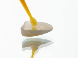 Teeth Bonding Diagram