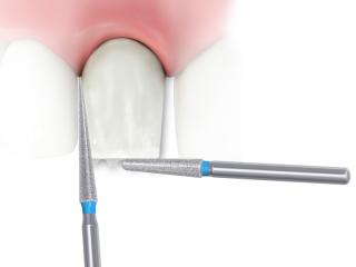 Tooth Contouring and Reshaping Diagram