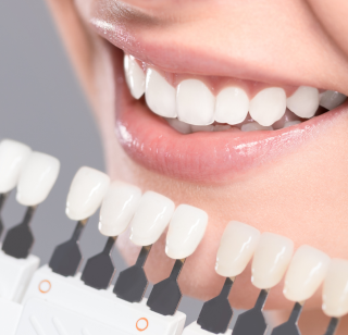 dental veneers faqs