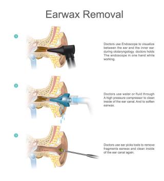 professional earwax removal