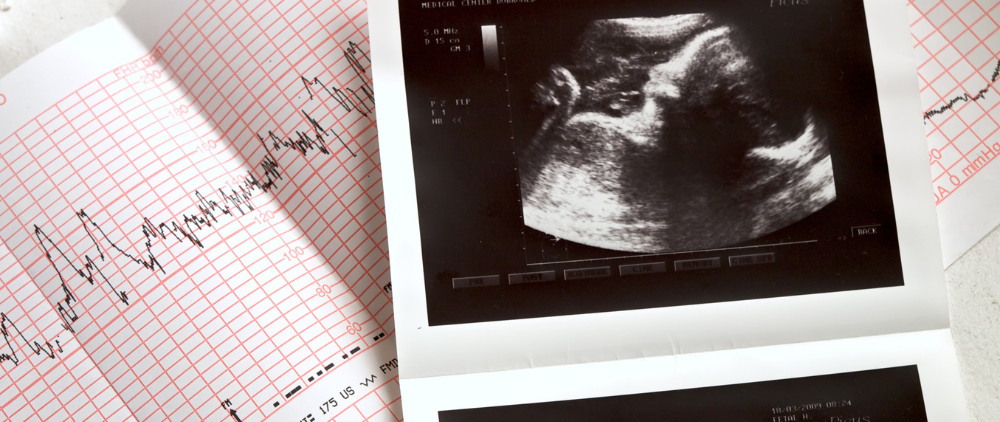 Did Evangelicalism Help Formulate Trump’s Views on Abortion?