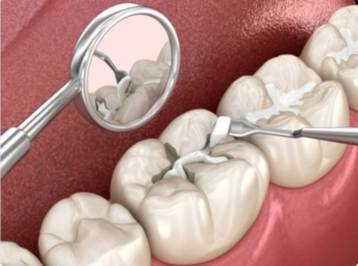 What Are Dental Sealants?
