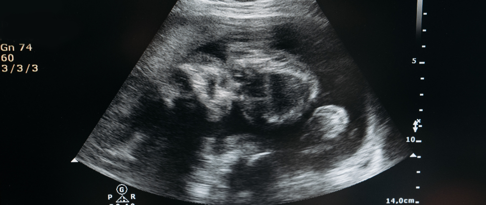 Abortion Drug Controversy – Part I: FDA Quietly Approves Generic Abortion Drug