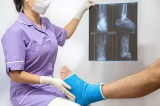 a nurse holding a broken foot in a blue cast alongside xray images of the broken foot