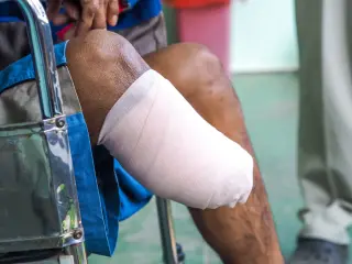 Catastrophic amputation injyry limb loss victim