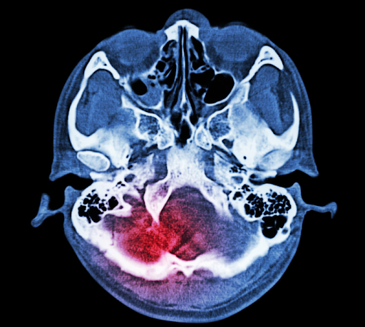 Traumatic brain injury from car accident