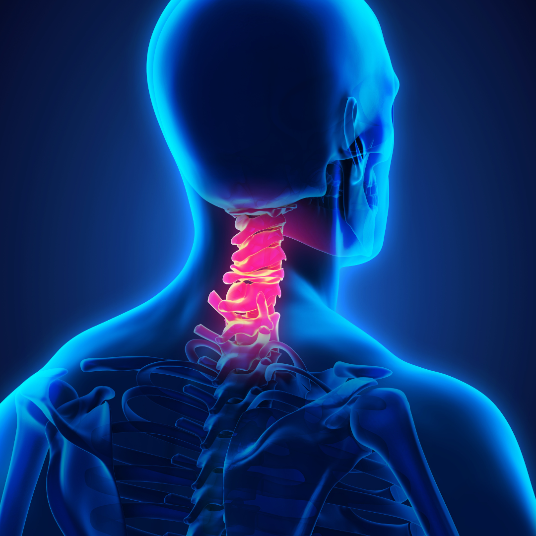 Graphic of a neck injury